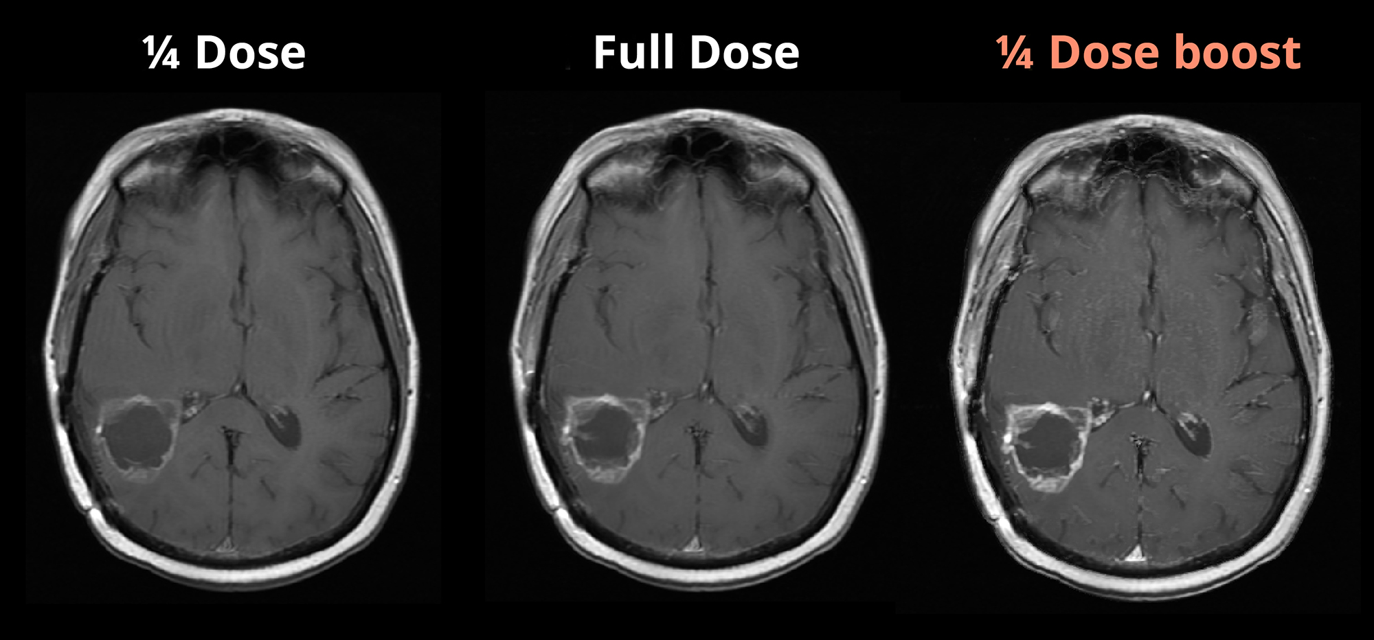 eGad Reduced Dose